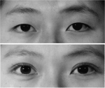 Opération pour la double paupière